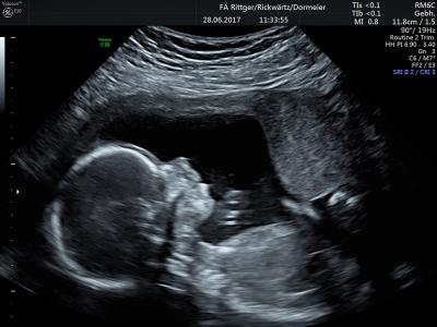 ultraschallbilder 4 monat